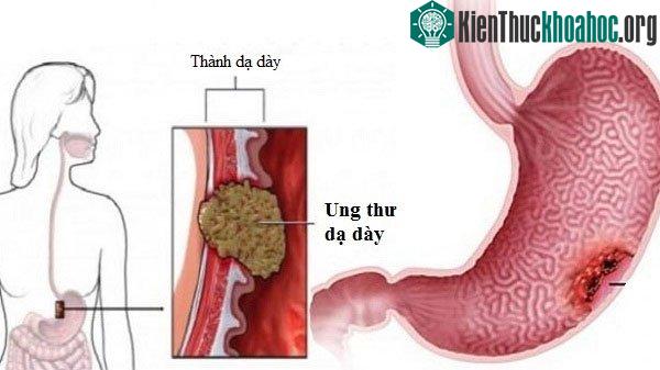 Ung thư dạ dày