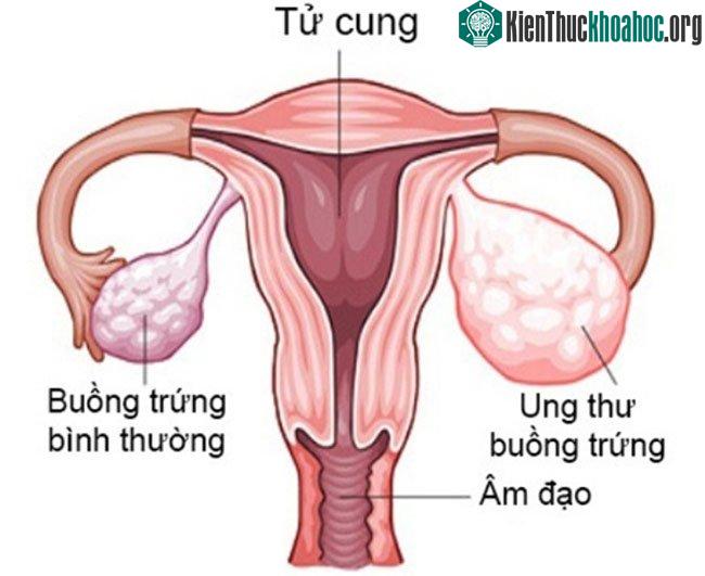 Ung thư buồng trứng