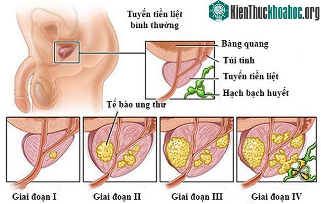 Ung thư tuyến tiền liệt