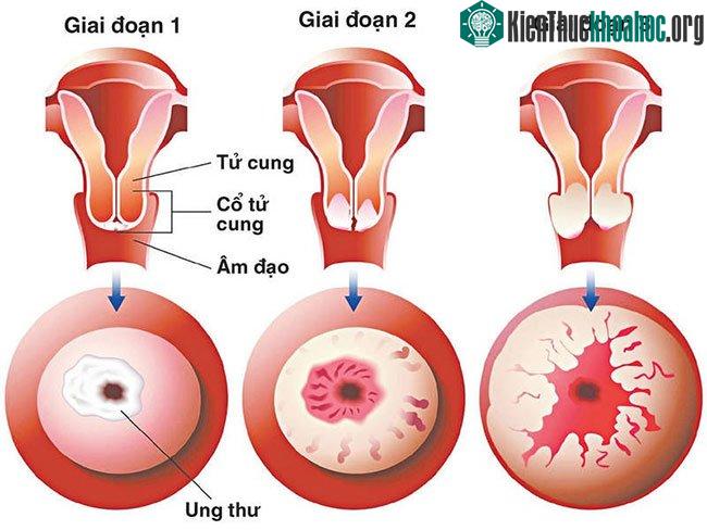 Ung thư cổ tử cung