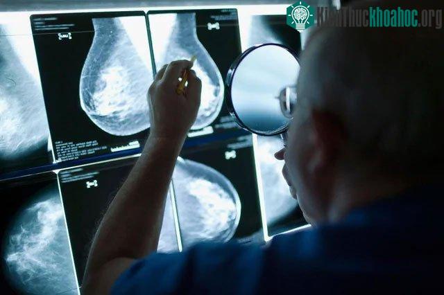 Tiêu diệt gene AAMDC sẽ tăng cường khả năng điều trị ung thư vú
