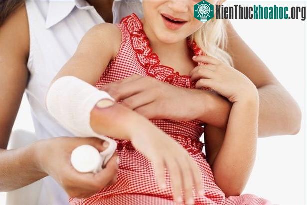 Sơ cứu khi bị bỏng