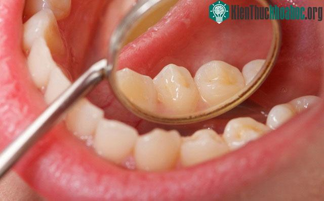 Người bệnh có thể phát hiện ung thư khoang miệng do những dấu hiệu khá dễ dàng nhận thấy