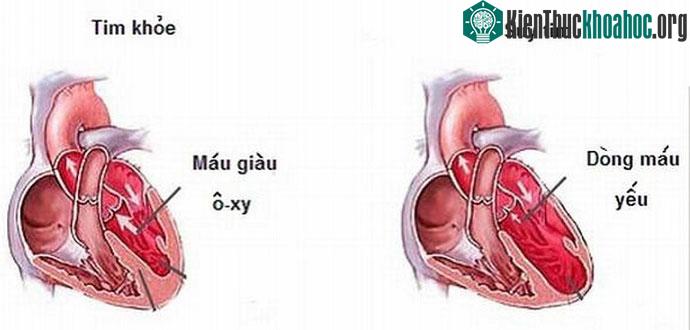 Tim khỏe và suy tim