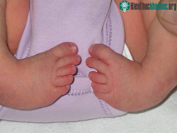 Hội chứng co cơ khớp bẩm sinh không có cách điều trị dứt điểm.
