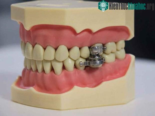 Chiếc khóa hàm mang tên DentalSlim Diet Control.