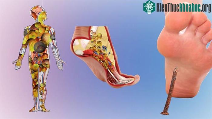 Vaccine uốn ván được tiêm trong một loại tổng hợp vaccine cho cả các bệnh bạch hầu và ho gà.