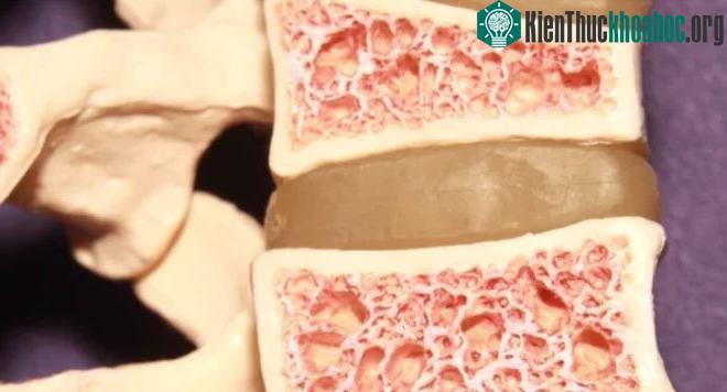 Chứng sclerosteosis