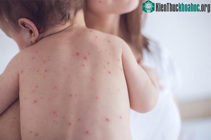 Bất cứ ai cũng có thể bị lây nhiễm nếu ở trong cùng không gian với người mắc bệnh