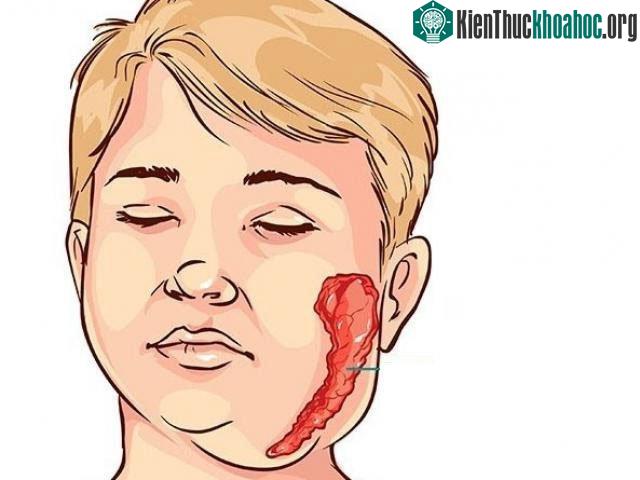 Quai bị rất dễ lây và không có thuốc điều trị.