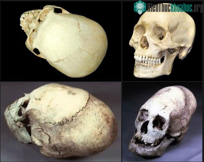 Ảnh trên: một hộp sọ người. Hình dưới: hộp sọ Anunnaki