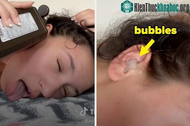 Tiktoker Ayisha sử dụng dung dịch oxy già để làm sạch tai.