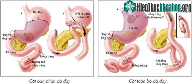 Phẫu thuật cắt bỏ dạ dày.