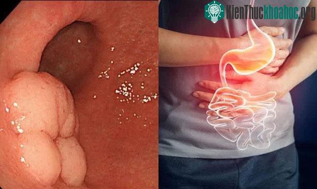 Viêm loét dạ dày có thể bắt đầu bởi những cơn đau âm ỉ sau hoặc trước bữa ăn