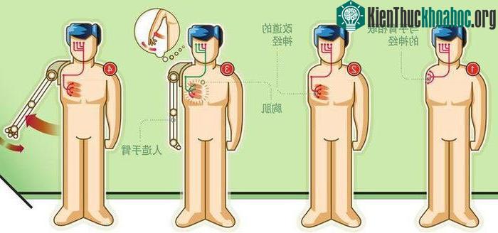Kỹ thuật “tái tạo cơ có mục tiêu” (target Mechanical reinnervation),