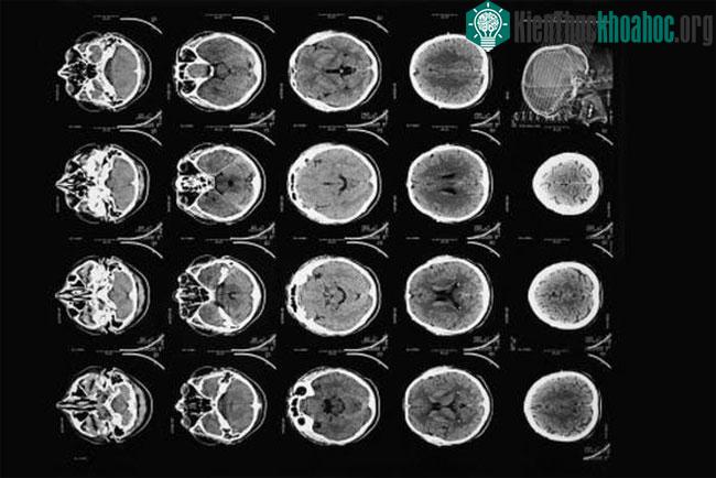Chụp cắt lớp CT hiện đại