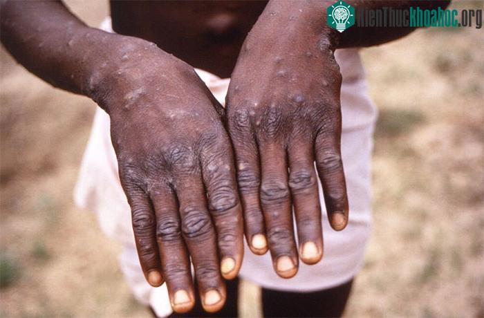 Nguy cơ virus đậu mùa khỉ lây lan qua các giọt bắn đường hô hấp trên máy bay là thấp.