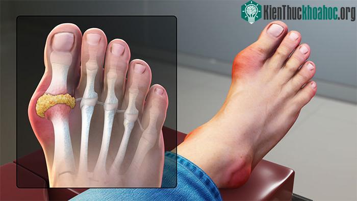 Bệnh Gout là một loại viêm khớp khác gây ra những cơn đau dữ dội