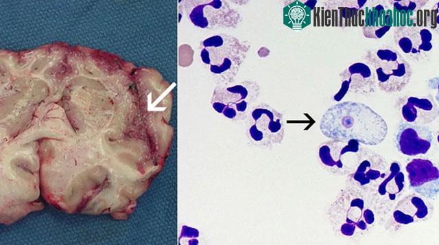 Naegleria fowleri