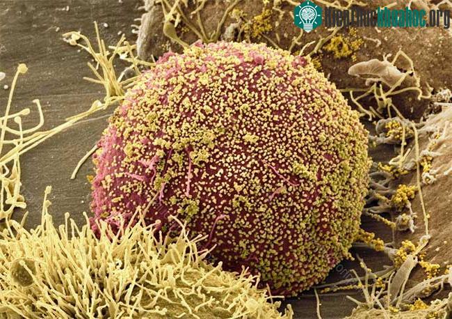 Virus HIV (màu vàng) bao quanh tế bào bệnh nhân.