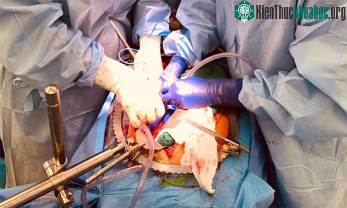 Ca ghép thận của heo cho người nhận bị chết não