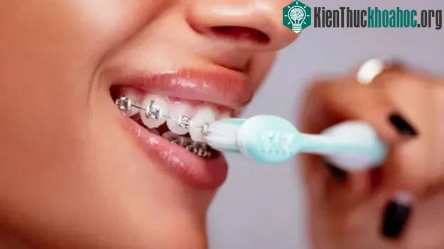 Thiết bị chỉnh nha đầu tiên ra đời vào đầu thế kỷ 18.&nbsp;