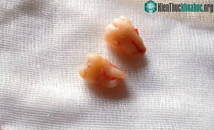 Giữ răng khôn bên dưới nướu làm tăng nguy cơ nhiễm trùng gây đau đớn và chết người
