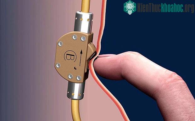 Phương pháp nút ống dẫn tinh cũng đang được các nhà khoa học phát triển.