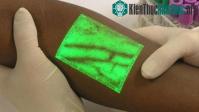 Ảnh Thiết bị hiển thị ven trên bề mặt da