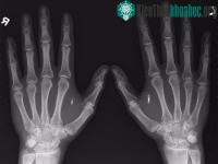 Ảnh 4 thiết bị cấy ghép cực nhỏ biến bạn thành siêu nhân