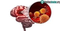 Ảnh Tìm hiểu về "U nguyên bào thần kinh đệm"