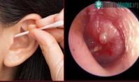 Ảnh Ráy tai thế nào coi là bình thường?