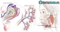 Ảnh Dấu hiệu nhận biết sớm bệnh ung thư tuyến nước bọt