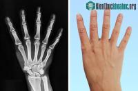 Ảnh Top 7 đặc điểm đột biến độc đáo ở trên cơ thể mà rất ít dân số trên thế giới may mắn sở hữu
