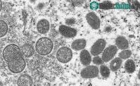 Ảnh Chủng virus đậu mùa khỉ tại Ấn Độ khác với chủng ở châu Âu