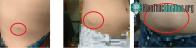Ảnh Thủ phạm khiến vùng kín người đàn ông xuất hiện "vật thể lạ", sưng phồng, chạy lên bụng