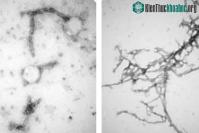 Ảnh Phương pháp mới "ngăn" bệnh Parkinson bằng công nghệ nano