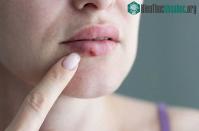 Ảnh Những bệnh có thể lây truyền qua nụ hôn