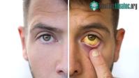 Ảnh Những dấu hiệu cảnh báo căn bệnh ung thư tuyến tụy