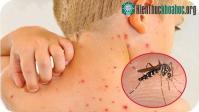 Ảnh Cách phân biệt bệnh sốt xuất huyết với sốt thông thường