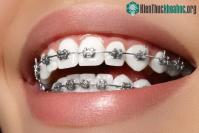 Ảnh Lịch sử chỉnh nha, niềng răng và những bí mật thú vị mài ít người biết