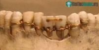 Ảnh Tìm hiểu lịch sử ra đời và phát triển của những chiếc răng giả