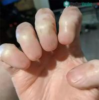 Ảnh Hình ảnh "dị nhân" tay không có móng, không có dấu vân tay