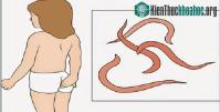 Ảnh Cách bắt giun kim cho trẻ em không phải dùng thuốc cha mẹ nên biết