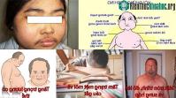 Ảnh Cảnh báo nguy hiểm khôn lường khi tự ý sử dụng corticoid