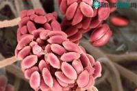 Ảnh Người đầu tiên trên thế giới bị nhiễm nấm từ cây trồng