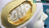 Ảnh Điện cực hình bông hoa bác sĩ phẫu thuật não ít xâm lấn hơn