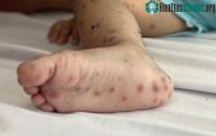 Ảnh Vaccine phòng tay chân miệng đầu tiên ở Việt Nam đạt hiệu quả tới 96,8%