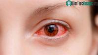 Ảnh Nhìn người đau mắt đỏ liệu có bị lây không?