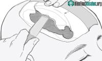 Ảnh Ca phẫu thuật hộp sọ phức tạp thực hiện từ 2.700 năm trước